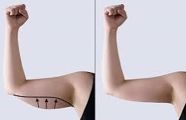 3D Arms Trim